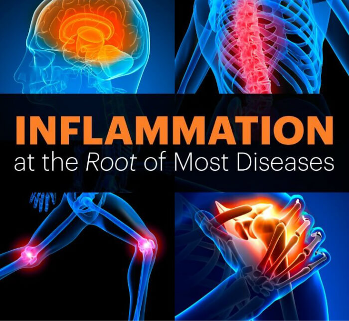 Inflammation Root of Most Diseases